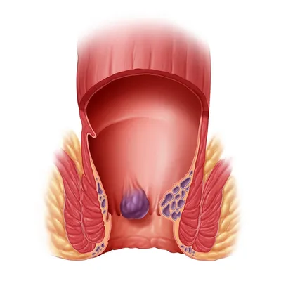 Геморрой: что такое? Как бороться? - статьи от компании Еламед