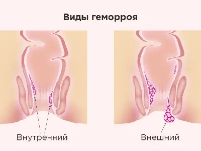 Препараты от геморроя - купить средство от геморроя в Украине | Цены в МИС  Аптека 9-1-1