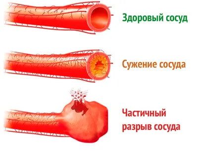 Геморрой: симптомы, причины, наружный и внутренний, стоимость лечения и  операции