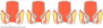 Лазерное лечение геморроя за 1 визит | Услуги клиники ЕВРОПА