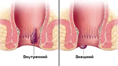 Тромбированный геморрой: причины, диагностика, симптомы и лечение