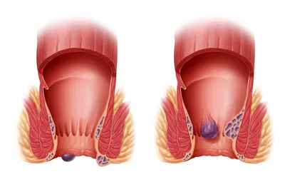 Геморроя картинки