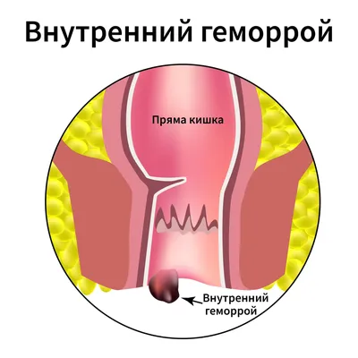 Геморрой - симптомы, лечение, причины и профилактика геморроя - Гармония