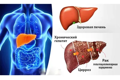 Лечение хронического гепатита С — Медицинский центр «Целитель»