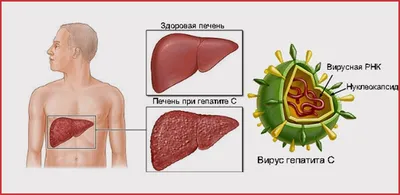 Что такое гепатит С?