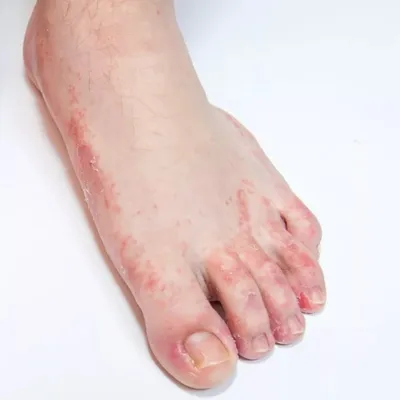 Сыпь на ногах": европейские врачи нашли новый симптом коронавируса /   - информационный сайт Кузбасса.