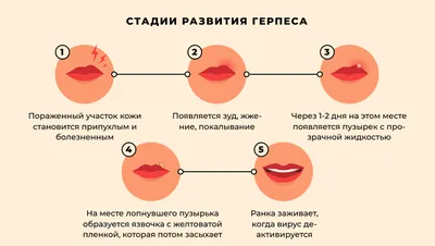 ТОП-8 мифов о герпесе — разбираем с врачами | Evolutis Clinic | Дзен