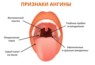 Вирусная ангина - лечение у детей и симптомы описаны в статье блога Furasol®