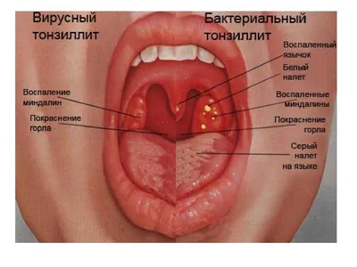 Герпесная ангина и сыпь по телу — 14 ответов | форум Babyblog