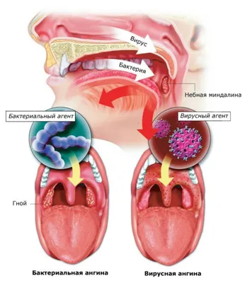 Вирусная ангина - лечение у детей и симптомы описаны в статье блога Furasol®