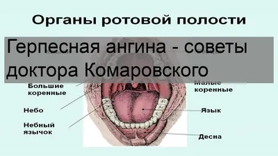 Как проявляется Герпесная ангина?