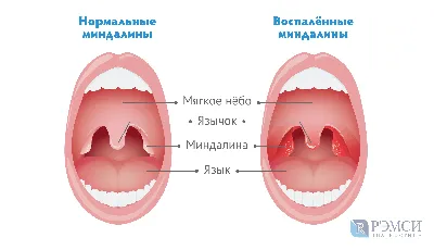 Герпетическая ангина — 4 ответов | форум Babyblog