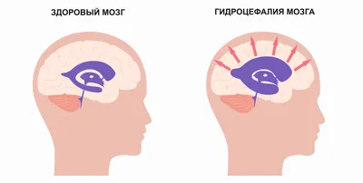 Гидроцефалия головного мозга (водянка): причины заболевания, симптомы,  диагностика, лечение гидроцефалии – Опытные неврологи в Москве – Клиника  НКЦ №2 (ЦКБ РАН)