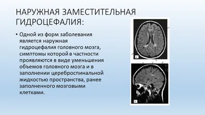 Презентация на тему "Гидроцефалия"