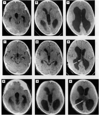 Гидроцефалия: симптомы, диагностика и лечение водянки головного мозга ⚕️  MedTour