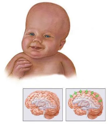 Гидроцефалия головного мозга - Нейрохирург в Тольятти