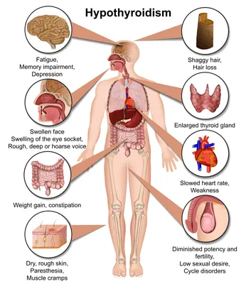 Гипотиреоз | симптомы, причины, описание заболевания, диагностика, лечение  и профилактика