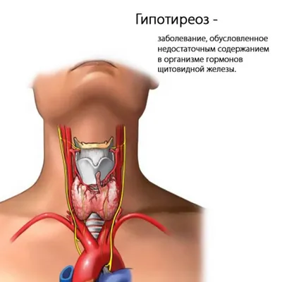 Гипотиреоз - MedTour