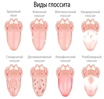 Лечение ромбовидного глоссита