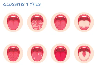 Что такое глоссит: что это, причины, симптомы и лечение