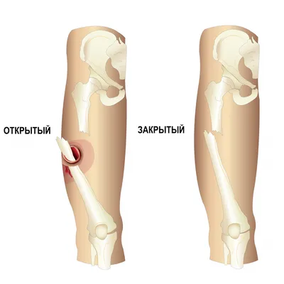 Перелом костей голени – 