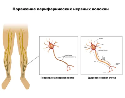 Вместе к цели - 📎 Внутренняя торсия голени. ▶️ Торсией голени называется  скручивание костей голени, кнутри, вдоль своей оси. Торсия возникает в  период внутриутробного развития. Ребенок рождается с определенной степенью  внутренней торсии,