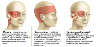 Абузусная головная боль - Доказательная медицина для всех