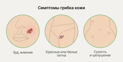 Лечение грибка кожи и дерматита в Харькове | Семейная консультация