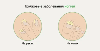 Лечение грибковых инфекций кожи и ногтей: противогрибковые препараты  широкого спектра действия