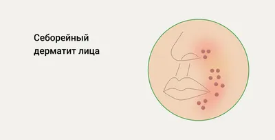 Дрожжевые инфекции: заболевания, лечение и препараты