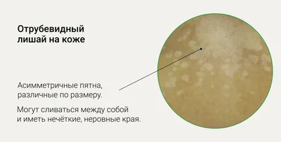 Розовый лишай - признаки, причины, симптомы, лечение и профилактика -  