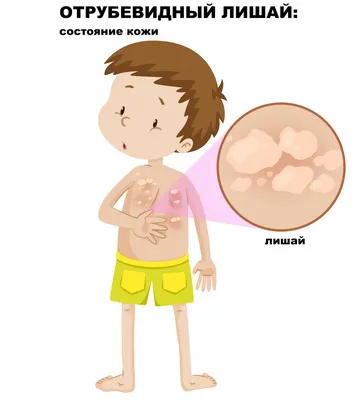 Грибковые заболевания кожи у детей - признаки, причины, симптомы, лечение и  профилактика - 