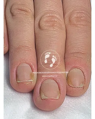 Грибок ногтей на руках заболевание грибковая инфекция на ногтях рук палец с  онихомикозом повреждения на руках человека | Премиум Фото