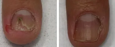 Лечение грибка ногтей на руках лазером