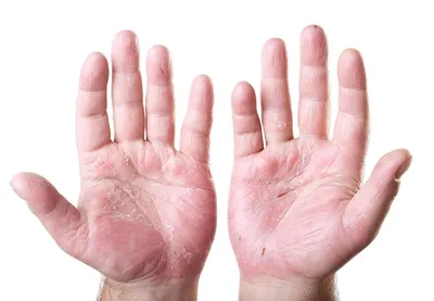 Грибок между пальцами на руках: причины, симптомы, что делать? | МедИнфо |  Дзен