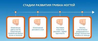 ᐉ Грибок ногтей на руках и ногах - основные признаки онихомикоза ногтя