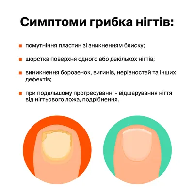 Как вылечить грибок ногтя на руке у ребенка? | Клиника подологии Н.  Базилевской на Оболони