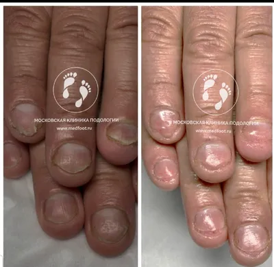 Грибок ногтей у детей: как лечить?
