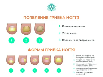 Грибок ногтей на ногах, чем лечить. Центр подологии Goltsberg