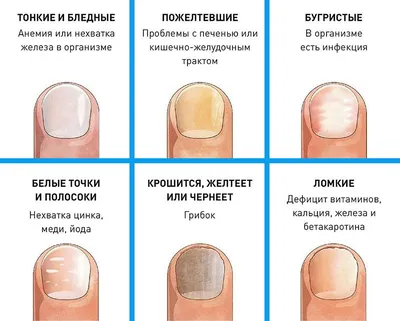 Лечение грибка стопы | Уход от грибка ногтей - Nailyuba