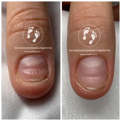 Безоперационное лечние ногтей на руках | Московская Клиника Подологии