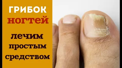 Лечение грибка ногтей на ногах, мед педикюр | Подология Крылатское, Кунцево