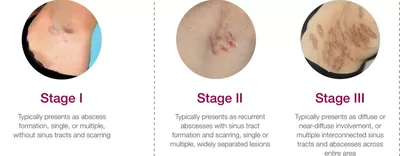 Hidradenitis suppurativa (syn. acne inversa)