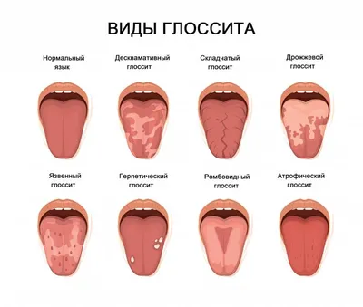 Врачи обнаружили у американца зеленый волосатый язык. По-видимому в этом  виноват антибиотик