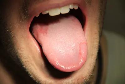 Чистка языка от налета в домашних условиях - Как правильно чистить язык при  чистке зубов