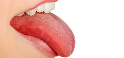 Лечение красных пятен на языке