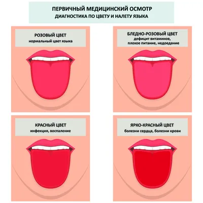 Налет на языке - причины появления, при каких заболеваниях возникает,  диагностика и способы лечения