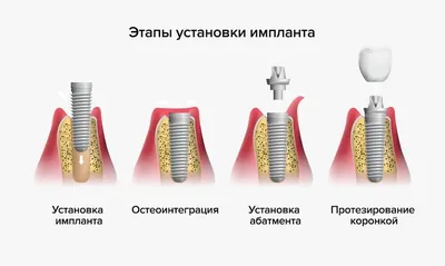 Имплантация зубов в СПб под ключ - цены на установку имплантов в клинике  «Бюджетная стоматология»