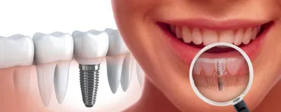 Как устанавливают импланты зубов – этапы установки импланта зуба