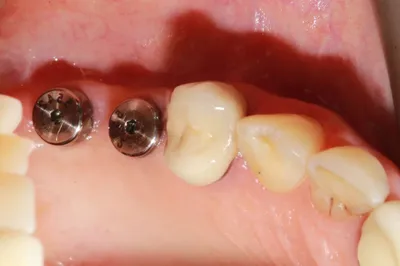 Имплантация зубов - недостатки и достоинства - Cтоматология Май